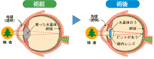 白内障 術前・術後の図解
