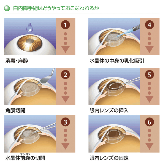 白内障手術の流れ